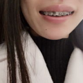 拔牙矫正小姐姐,小姐姐的美丽蜕变记